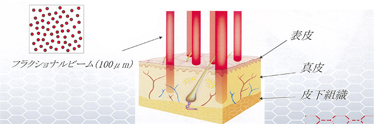 フラクショナル治療イメージ図