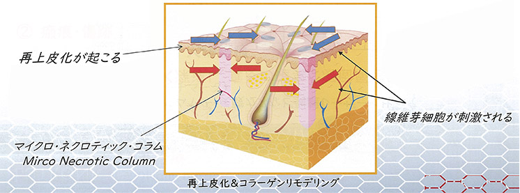 フラクショナル治療イメージ図