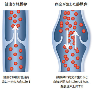 健康な静脈弁　病変が生じた静脈弁