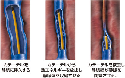カテーテルを静脈に挿入する　カテーテルから熱エネルギーを放出し静脈璧を収縮させる　カテーテルを抜去し静脈が閉塞させる。
